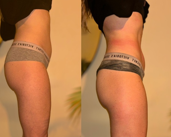 Avant et après un soin BA Sculpt : silhouette de profil