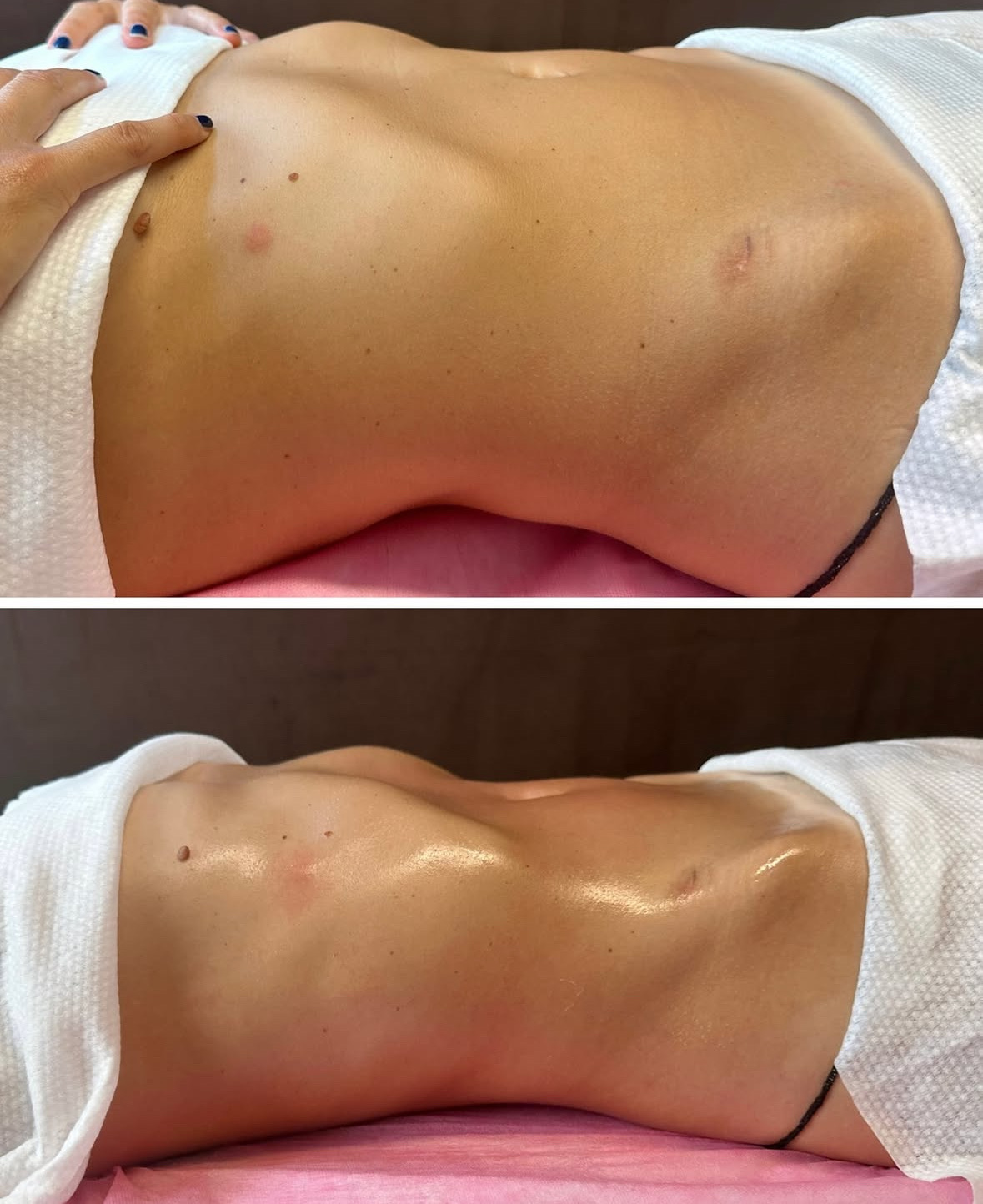 Avant et après un drainage lymphatique combiné à la madérothérapie : ventre affiné