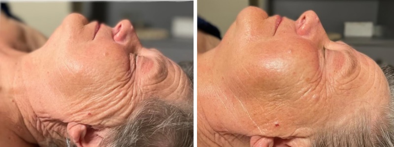 Avant et après un soin SculptLift : ovale du visage et cou redessinés